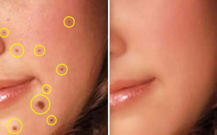 Loại bỏ mụn ruồi, mụn cóc 